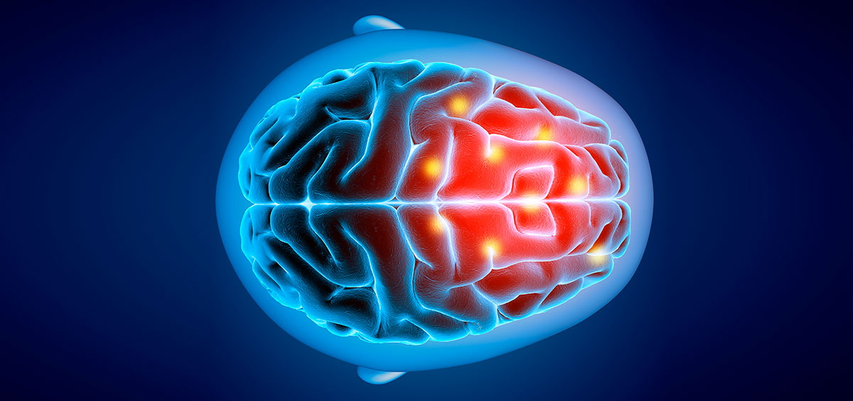 Imagem sobre Aneurisma Cerebral